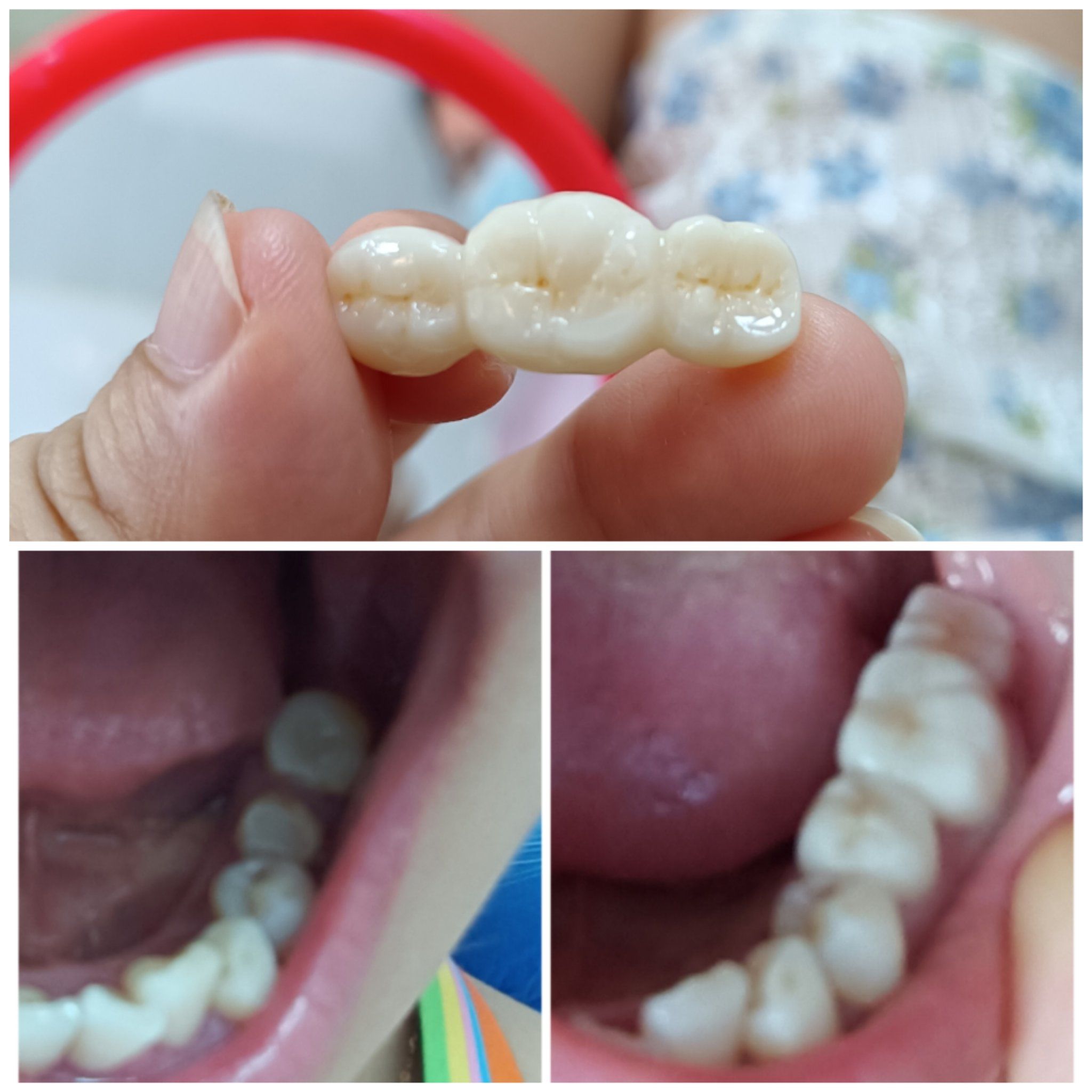 创作者赏金计划 做了两个三连冠#牙冠 #爱尔创氧化锆 #牙齿矫正