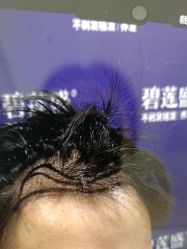 -碧莲盛·不剃发植发