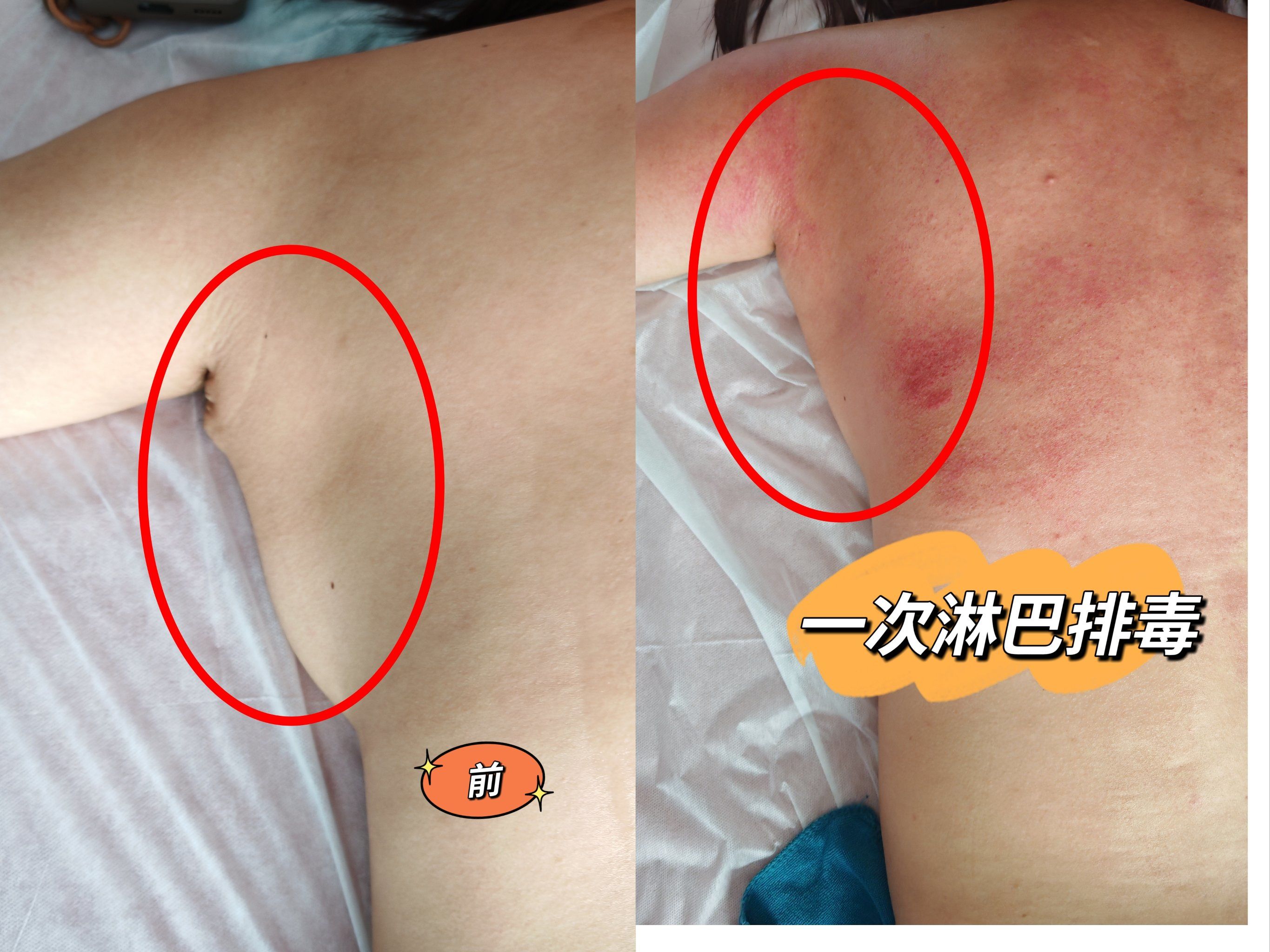 一次腋下淋巴排毒,副乳没了
​