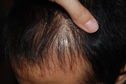 -大麦微针植发丨全国连锁