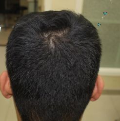 -大麦微针植发丨全国连锁