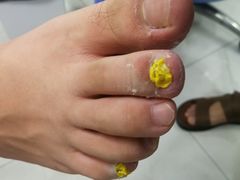 -Andrew指甲专科灰指甲·甲沟炎矫正·3D步态矫形鞋垫定制(浦三路店)
