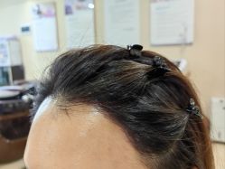 -碧莲盛·不剃发植发