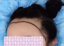 -大麦微针植发全国连锁