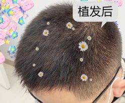 -大麦微针植发全国连锁