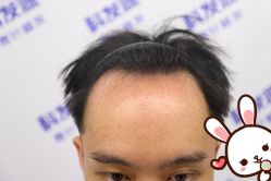 点击看大图 -大麦微针植发丨全国连锁