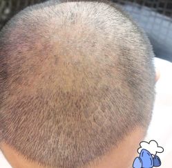 -大麦微针植发丨全国连锁