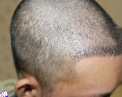 -大麦微针植发丨全国连锁