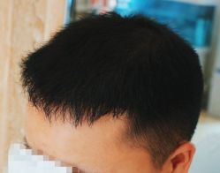 -大麦微针植发全国连锁