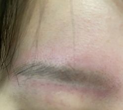 体验后-郡艺医疗美容·微整·眼鼻吸脂