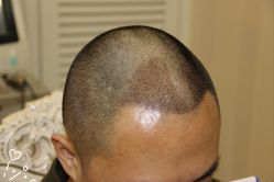 -大麦微针植发丨全国连锁