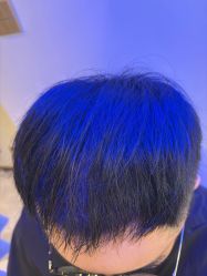 -碧莲盛·不剃发植发