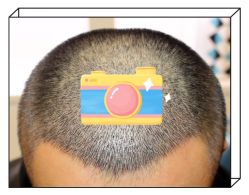 -大麦微针植发全国连锁