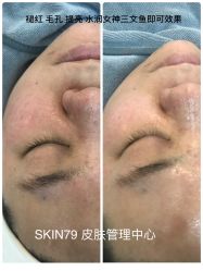 体验后-SKIN79皮肤管理中心