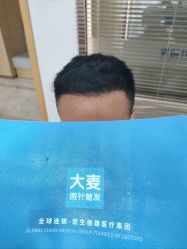 -大麦微针植发丨全国连锁