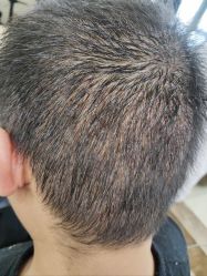 -碧莲盛·不剃发植发