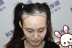 -大麦微针植发丨全国连锁