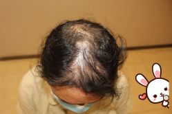 -大麦微针植发丨全国连锁