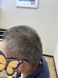 点击看大图 -大麦微针植发全国连锁