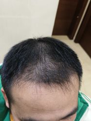 -碧莲盛·不剃发植发