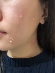 -北京美痣堂古方祛痣斑疣瘊