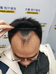 -大麦微针植发丨全国连锁