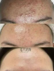 -瑶芳清颜草本祛痘