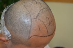 -大麦微针植发丨全国连锁