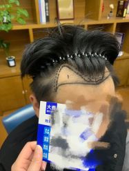 -大麦微针植发全国连锁