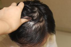 -大麦微针植发丨全国连锁