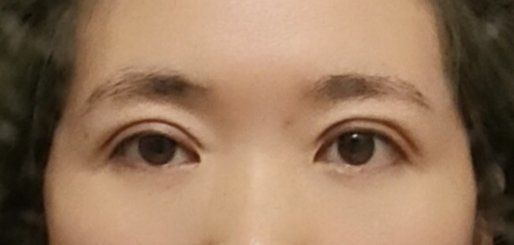 体验后-紫洁俪方（北京）医疗美容