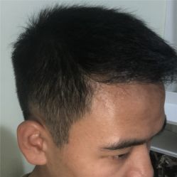 -碧莲盛·不剃发植发