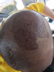 -碧莲盛·不剃发植发