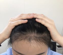 点击看大图 -大麦微针植发丨全国连锁