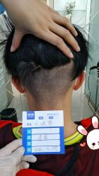 -大麦微针植发丨全国连锁