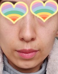 点击看大图 体验前-北京英煌医疗美容