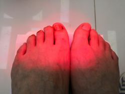 -派恩宜灰指甲鸡眼嵌甲手足癣