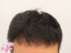 -大麦微针植发全国连锁