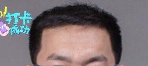 -大麦微针植发全国连锁