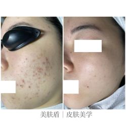 -美肤盾祛痘·问题肌头疗管理中心
