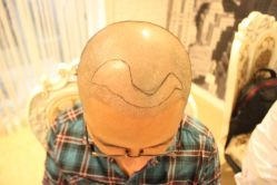 点击看大图 -大麦微针植发丨全国连锁