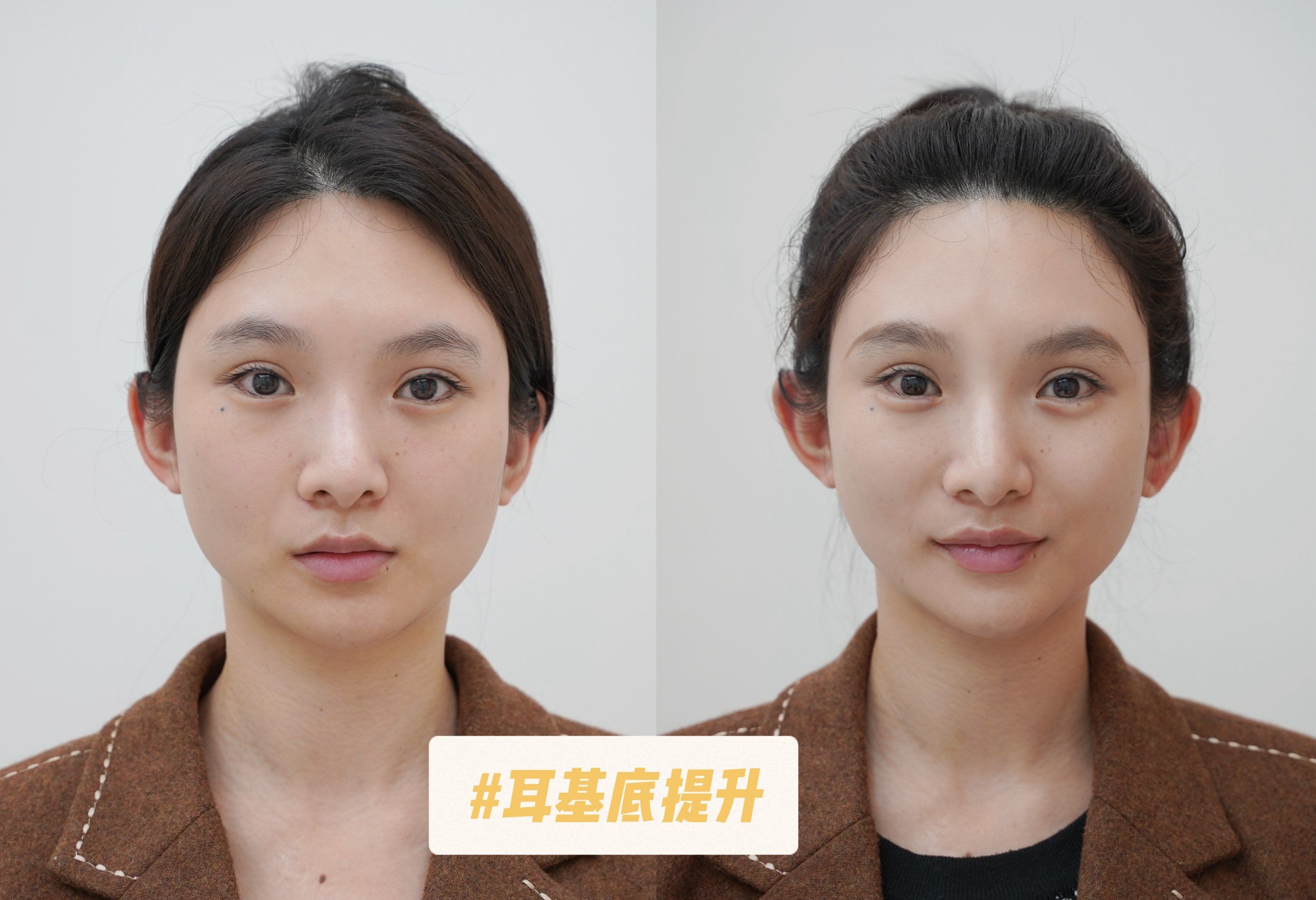 耳基底提升 翻车了吗