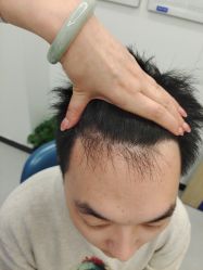 -大麦微针植发全国连锁