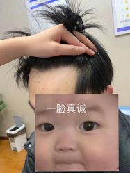 体验后-大麦微针植发全国连锁