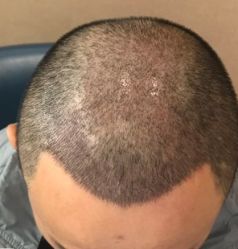 -大麦微针植发全国连锁