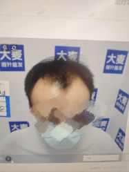 -大麦微针植发丨全国连锁