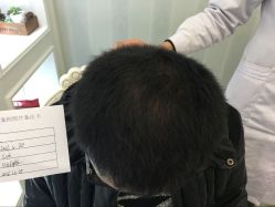 -大麦微针植发丨全国连锁