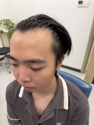 -大麦微针植发全国连锁
