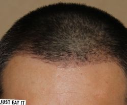 -大麦微针植发丨全国连锁