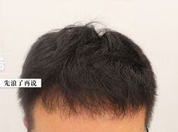 -大麦微针植发全国连锁